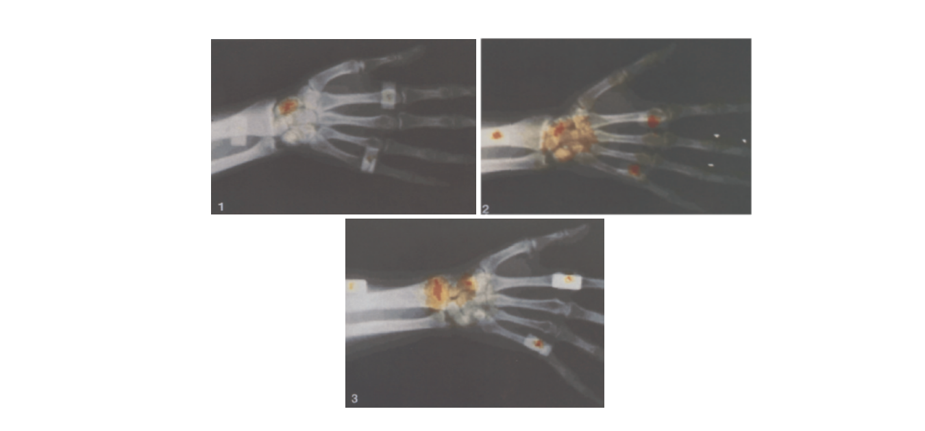 Hand X-ray fusion